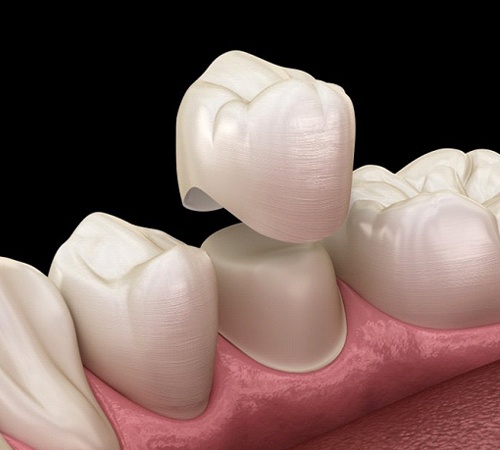 Dental Crowns Services In Houston TX